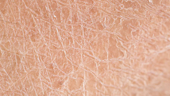 Yoğun Nem, Yumuşak Ayaklar