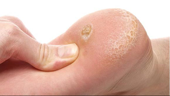 Sertleşmiş Nasırları Yumuşatır